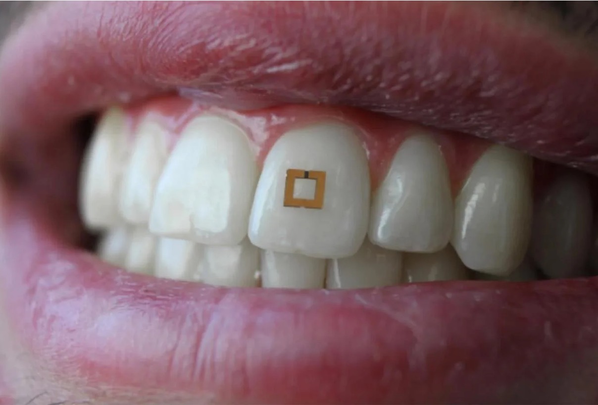 Image of a tooth-implanted food sensor